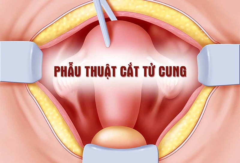 Bệnh khu trú trong tử cung tại thời điểm phẫu thuật, tiến hành cắt toàn bộ tử cung